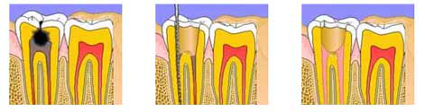 Endodontics Treatment