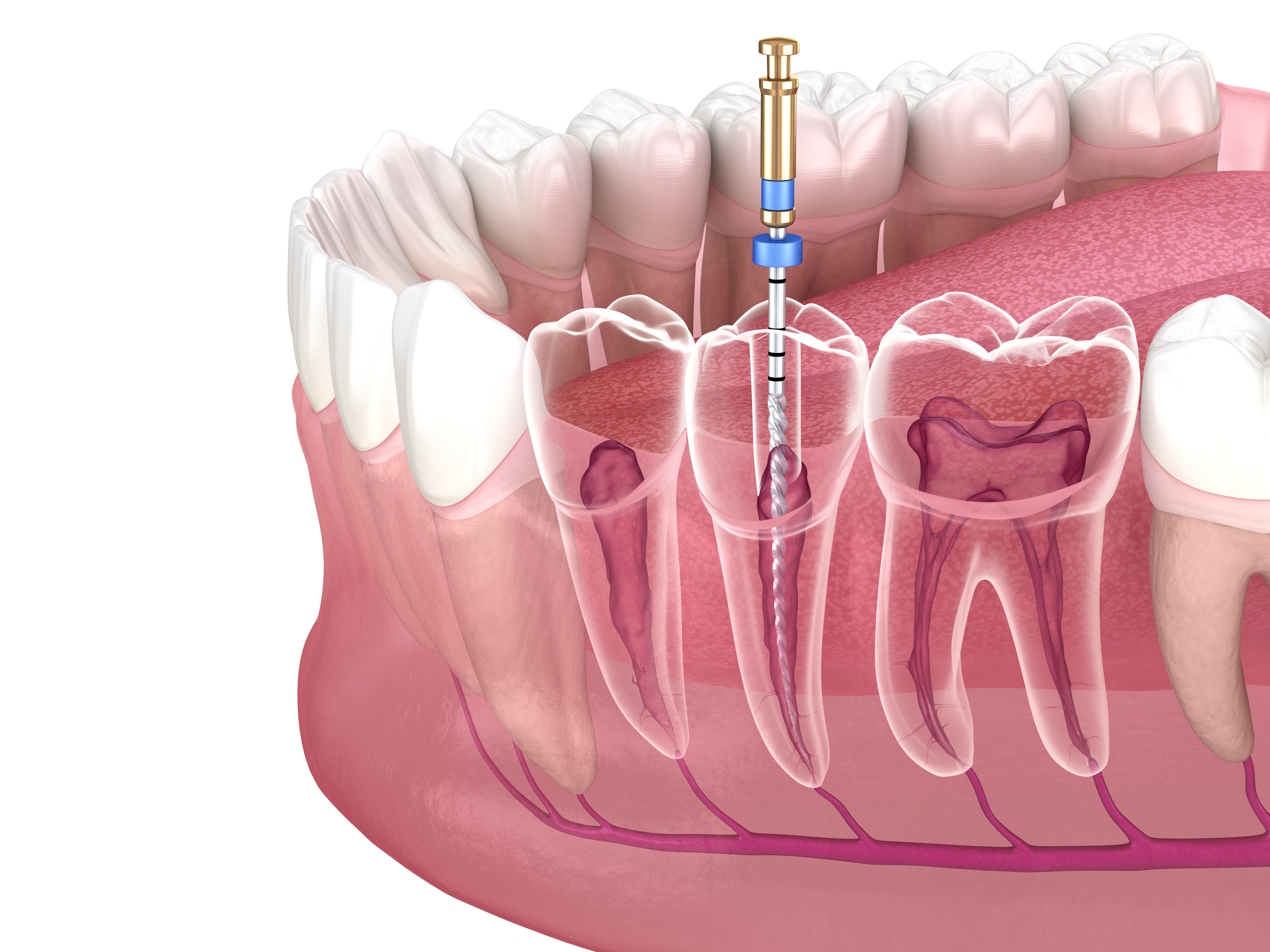 Endodontics/Root canal treatment